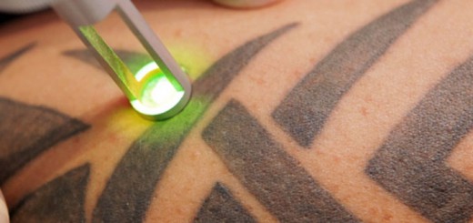 Tattoo Removal